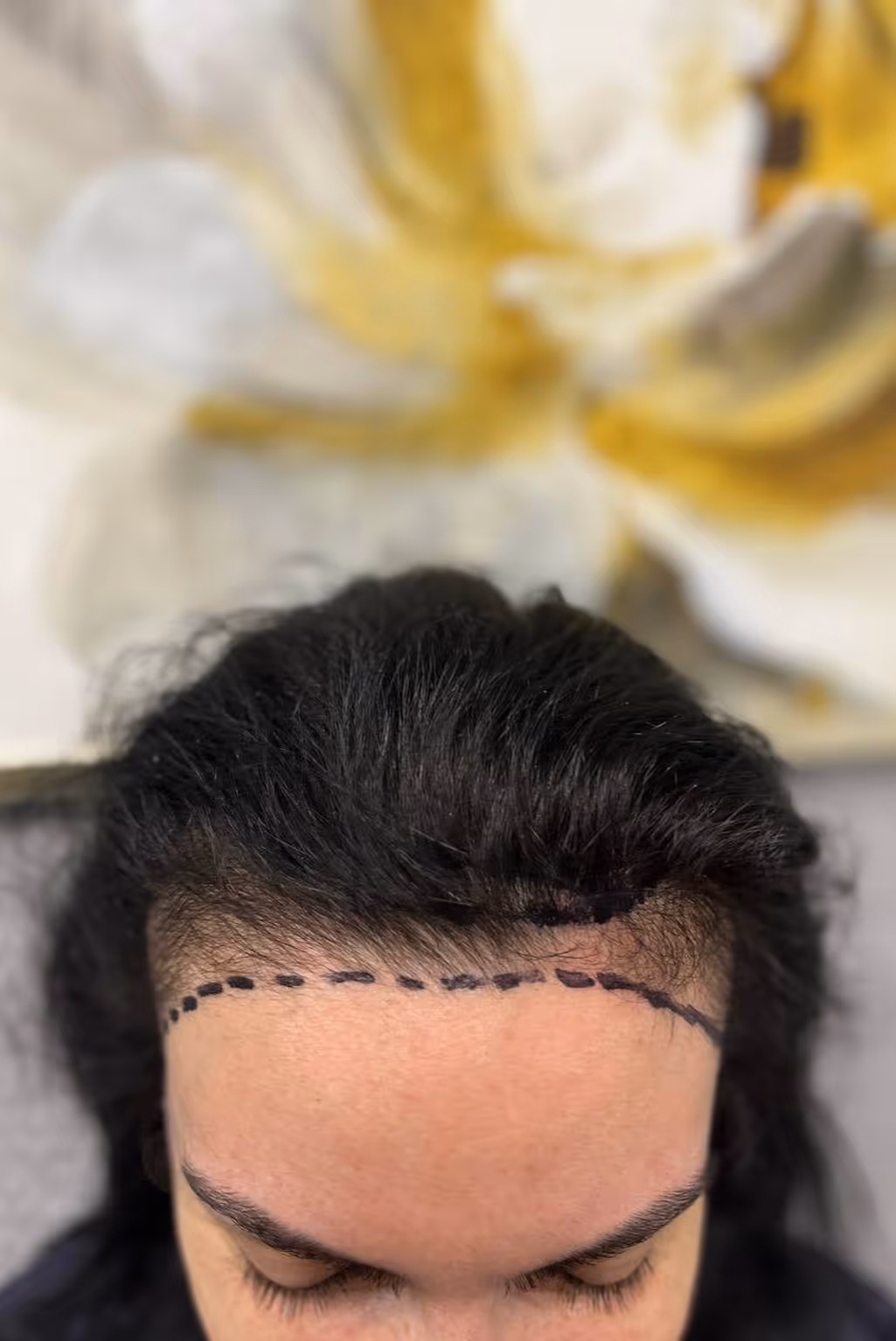 Estetime hair transplant service for women.